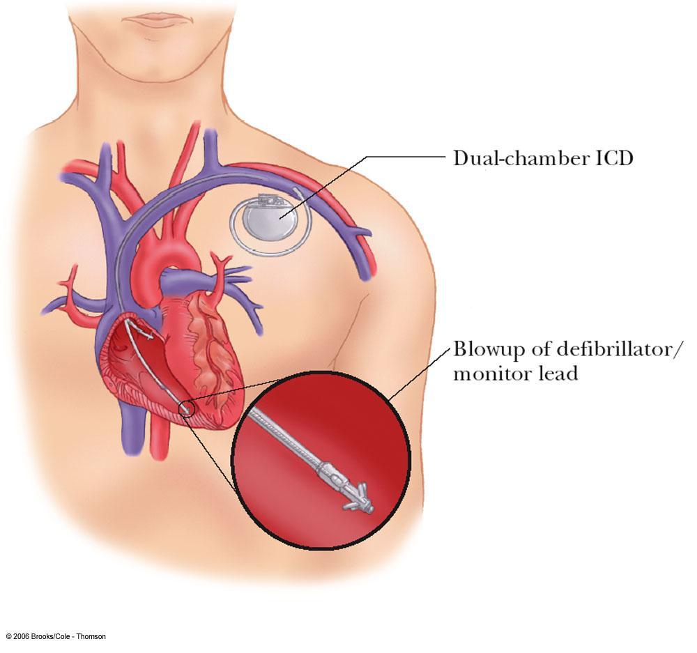 Implanted Cardioverter Defibrillator (ICD) Devices that can monitor, record and logically