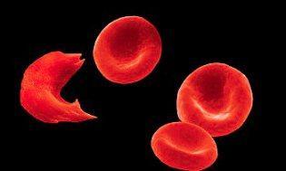 Sickle Cell Anemia Mutation in hemoglobin gene Distorted red blood cells sickling Cell