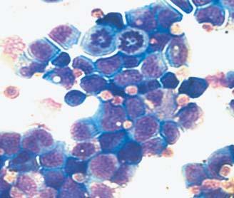 leukoblasts in the bone marrow of recipient mice transplanted with CKD-HMG cells (left, 2x magnification, ar