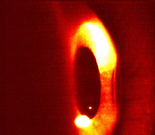 Figure 3.3: The indented human cornea displays three distinct markings in the images captured with the inferior camera.