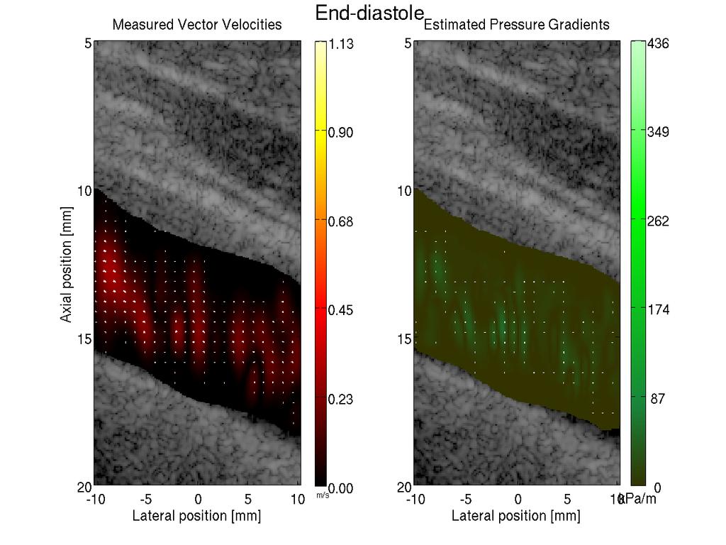 2 Pressure gradients during pulsatile flow Pressure gradient Velocity.8 advantage of using ultrasound for estimating pressure gradients 15 1 5.6.4.2 Velocity [m/s].5 1 1.5 2 2.5 3 3.
