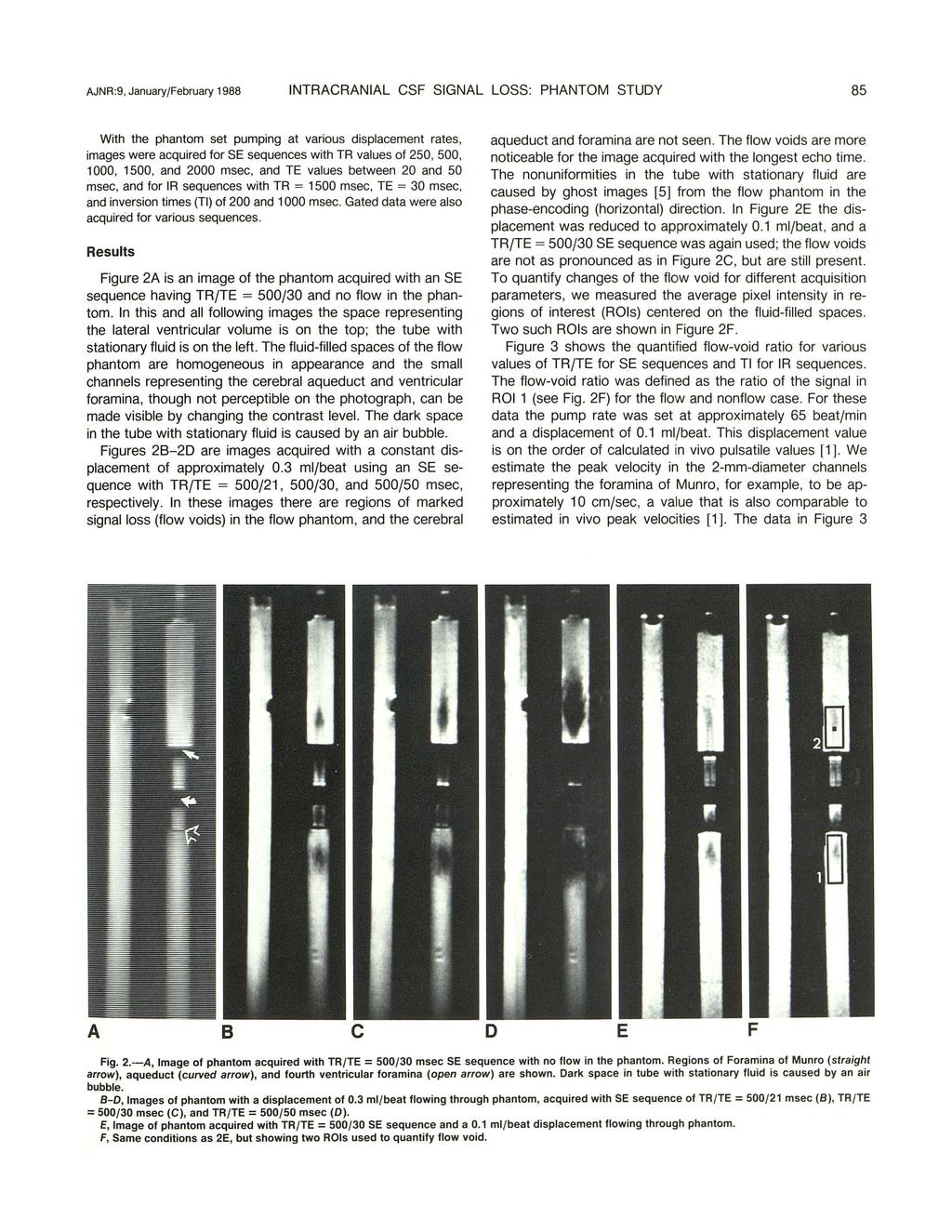 AJNR :9, January/February 1988 NTRACRANAL CSF SGNAL LOSS: PHANTOM STUDY 85 With the phantom set pumping at various displacement rates, images were acquired for SE sequences with TR values of 25, 5,
