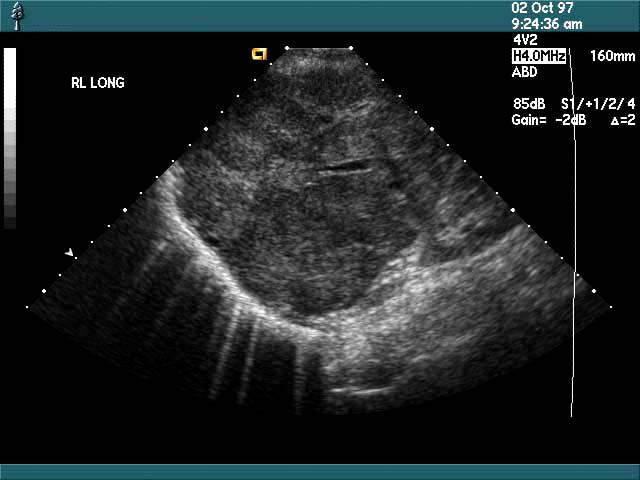 a longitudinal ultrasound image