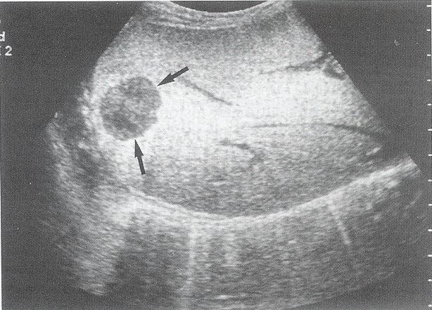 lobe of the liver FI: without ultrasound contrast
