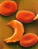 cells leads to anemia Sickle cells damage the heart, brain and other organs Symptoms include: frequent infections, paralysis,