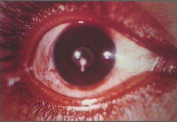 Example 4: Taenia worm in human eye Worm infects human blood