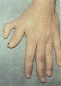 Polydactyly-