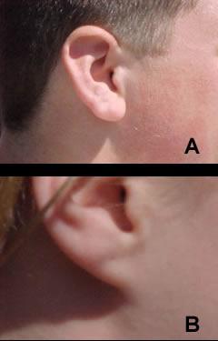Variations in humans Blood type Ear