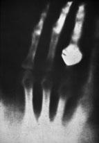 Röntgen found that X-rays were able to penetrate some materials, such as paper and skin, but not others, such as bone and metal. Röntgen took the first X-ray image (Figure 5).