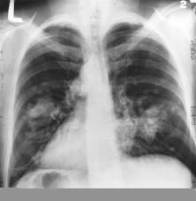 Example: Classification Medical diagnosis: Based on the X-ray image, we would like determine whether the patient has cancer or not.