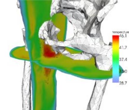Hyperthermia treatment planning Computer modeling can be used to