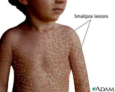 Smallpox, Ebola, Herpes, AIDS, Chicken pox, Rabies Viruses disrupt