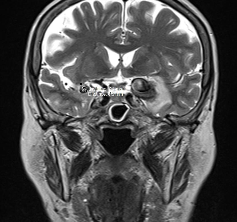 3: Segmentacija crno-bijele slike Elaine Primjer 3.7. Na Slici 3.4a-b prikazana je crno-bijela slika ljudskog mozga 1, a na Slici 3.