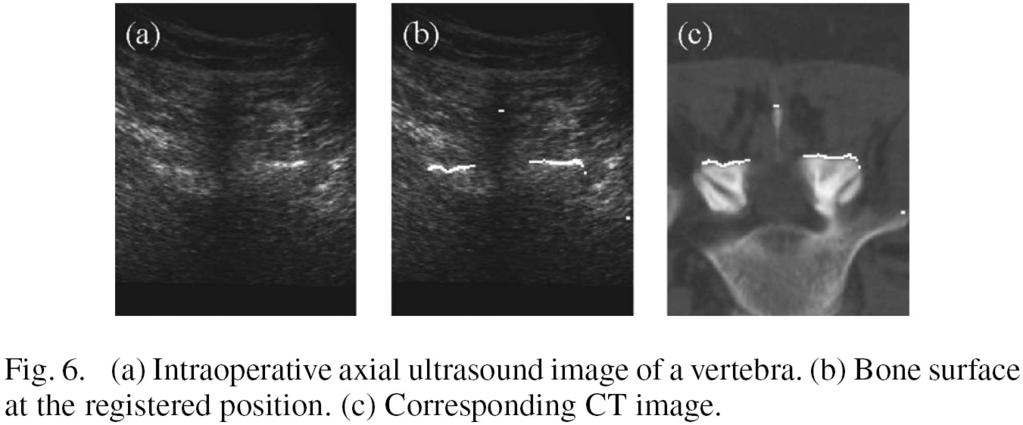 On-line registration of spline images Intraoperative ultrasound image CT image from [Winter et al 2008,