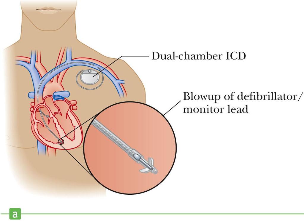 Implanted Cardioverter Defibrillator Devices that can monitor, record and logically process heart
