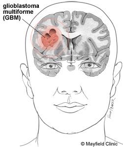 Figura 1: Illustration of a glioblastoma tumour in the parietal lobe. with terms that will be well determined by recursion and that gives rise to the solution components.