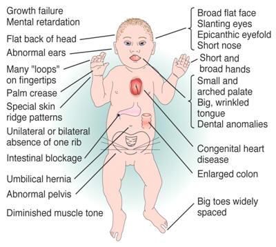 Trisomy 21- Cause of Down