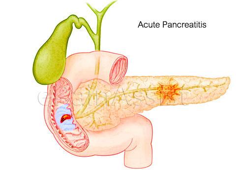 Acute Pancreatitis (AP) What is Acute Pancreatitis?