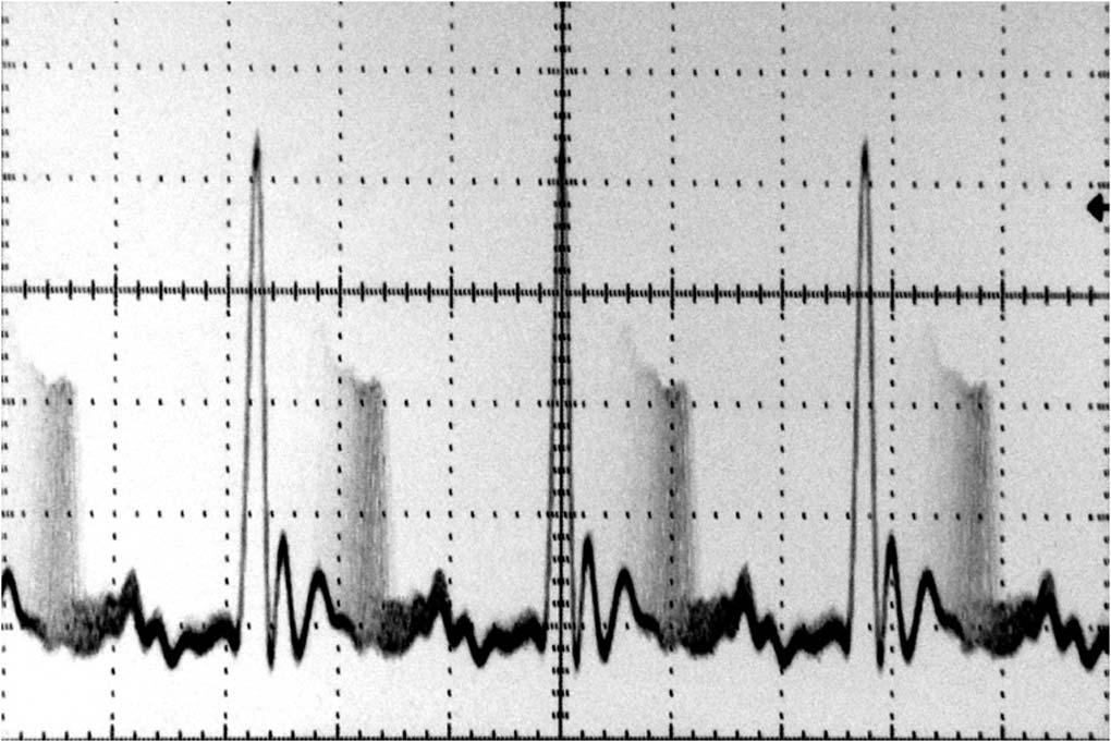 224 N. Akhmediev et al. / Optical Fiber Technology 11 (2005) 209 228 Fig. 15. Oscilloscope traces of doublet plus moving singlet soliton.
