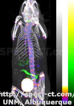 SPECT Dual Isotope Imaging 99m Tc-MDP (red-blue) bone scintigraphy