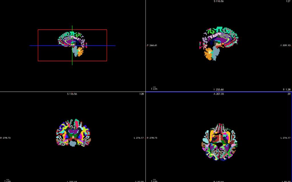 Figure 4.1: The sagittal, axial and coronal views (in clockwise order) of the parcellated white matter volume output by Freesurfer.