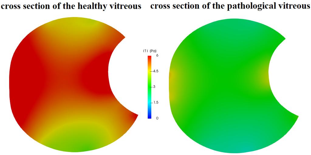 Results Quantification of the stress in a deforming eye Higher stresses in the healthy vitreous damp the external