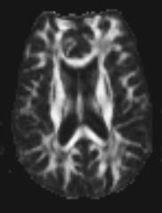 Diffusion Imaging Techniques Fractional Anisotropy Black: Water or cerebrospinal fluid