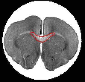 Diffusion Imaging Techniques 3D DTI Segmentation of the Corpus Callosum (Using KL-S) Figure: Top: a 2D slice of the corresponding evolving