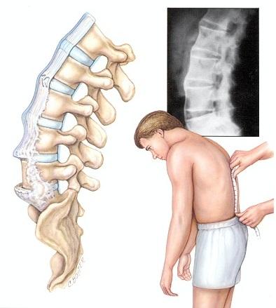 Ankylosing Spondylitis Chronic inflammatory disease of the axial skeleton Epidemiology : Age at first symptoms : 20-30 years Sexe : predominance for men (sex ratio 2M :1W) Prevalence : depend of