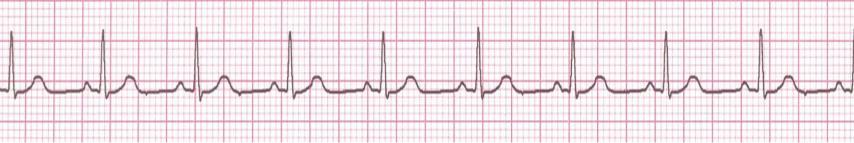 Feature Extraction The general approach of the doctors base on the following ECG (ElectroCardioGram) is done by calculating the heart rate and the duration of each special waves in the ECG signal.