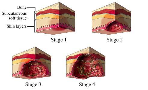 Fig. 2. Different stages of pressure ulcers according to EPUAP [9] Fig. 3. Maxwell model (spring in series with dashpot) [12] III.