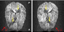 Figure 3.16: Axial slice of diffusion-weighted images (DWI) with two different diffusion gradient directions (red arrows).