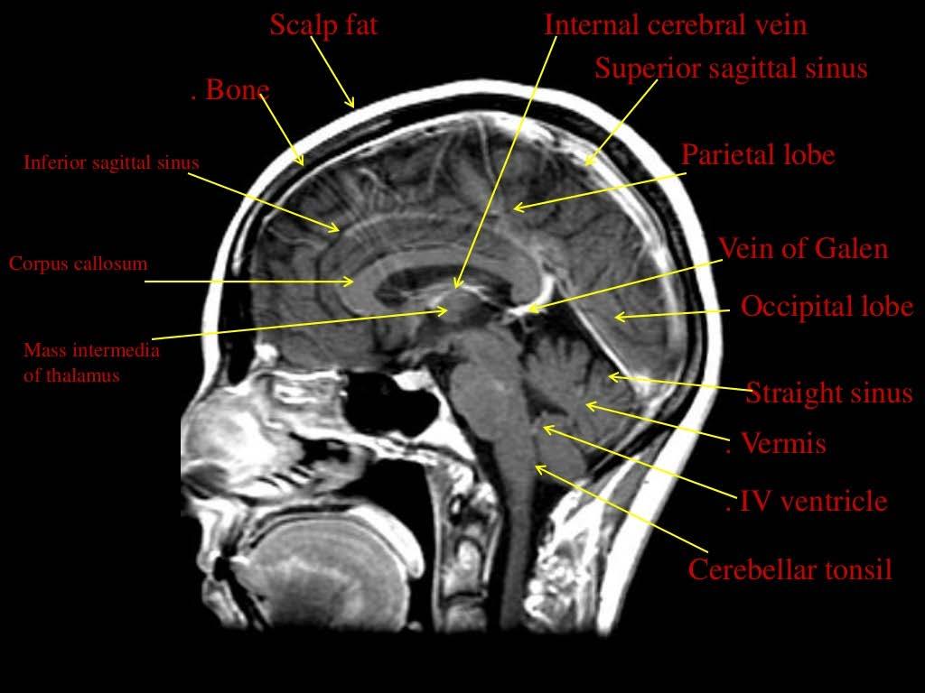 MRI images of