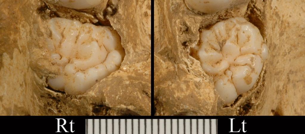 Denisova Cave Versus Peştera cu Oase 197 Figure 1. Occlusal views of the Oase 2 maxillary third molars (M 3 s). Scale in mm.