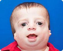 Craniofacial Abnormalities Treacher Collins Syndrome Autosomal Dominant Affects Cranial