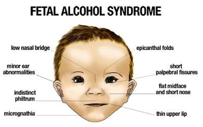 Craniofacial Abnormalities Fetal Alcohol Syndrome Alcohol