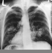Example: Classifica:on Medical diagnosis: Based on the X- ray image, we would like determine whether the pa:ent has cancer or not.