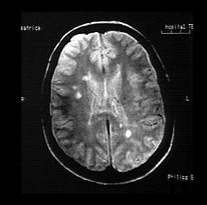 Images collected in 1985 Multiple sclerosis Clinical trials for MRI began in 1983, FDA