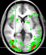 First human functional MRI paper: Bandettini, Wong, et al.