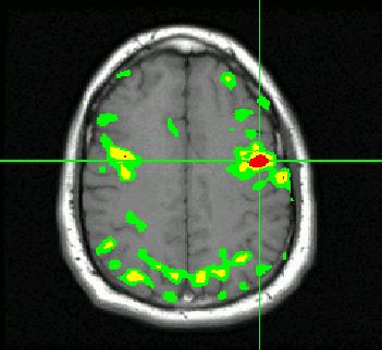 Caveats regarding fmri: Tertiary measure of neuronal activity. Very small signal changes, on order of 1 to 2%.