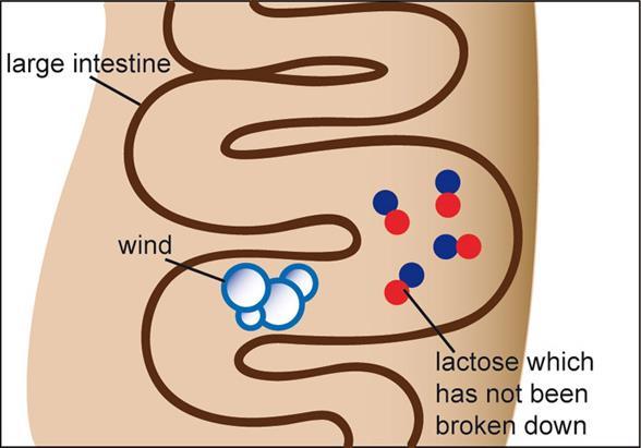 CASE STUDY: LACTOSE INTOLERANCE Lactase breaks down