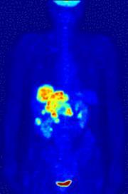 PET Scan imaging technique based on positron emission positron + electron gamma rays isotope incorporated into a molecule molecule ingested