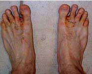 Name The Relationship Athlete s foot is a common fungal infection of the skin of your feet.