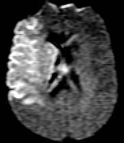 Diffusion-weighted imaging In 1990, Moseley et al demonstrated in an animal stroke model