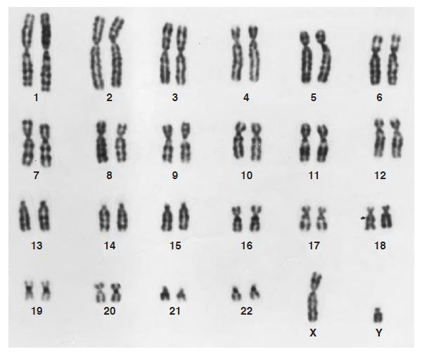 Photographs of human chromosomes in duplicate, as isolated just before cell division (at metaphase) and then sorted by length into pairs.