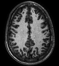 Diffusion Tensor Imaging (DT MRI) reveals White