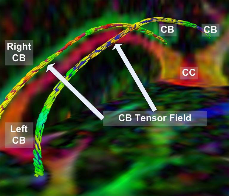 Alternative methods for tractography Tracking in vector-field of largest eigenvector Tracking in tensor field Probabilistic tractography Optimal path analysis Fiber tract by