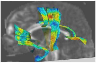 Tractography for ROI definition