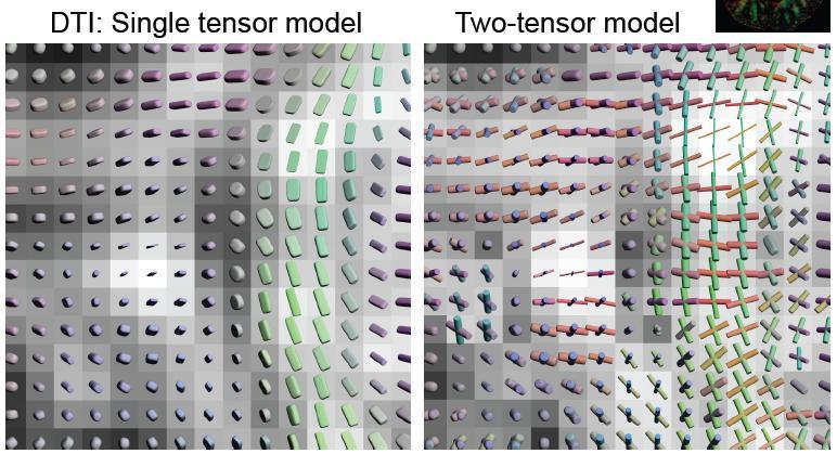 Two Tensor Model (C-F Westin, S Peled, G