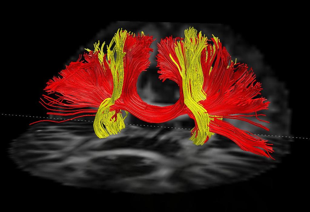 Tractography Close to standard DTI protocols